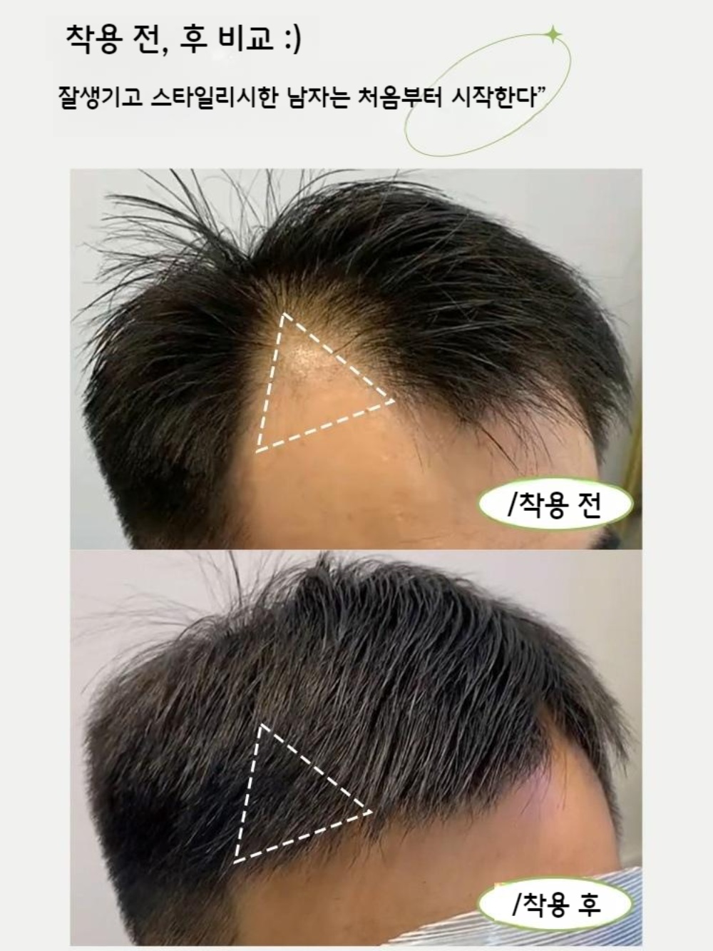 M자 이마 헤어라인 가발 패치