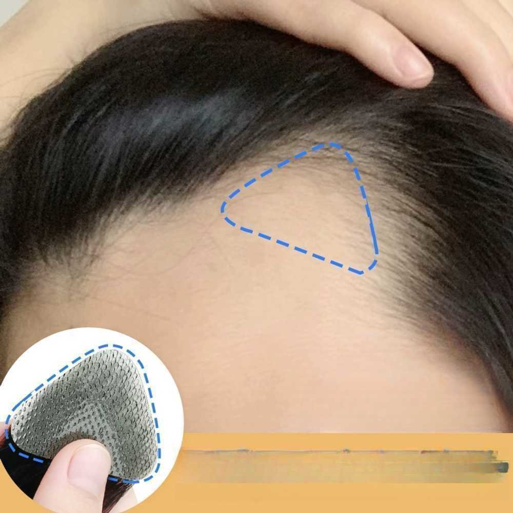 헤어라인 가발패치 대머리 커버 M자이마 부분 가발