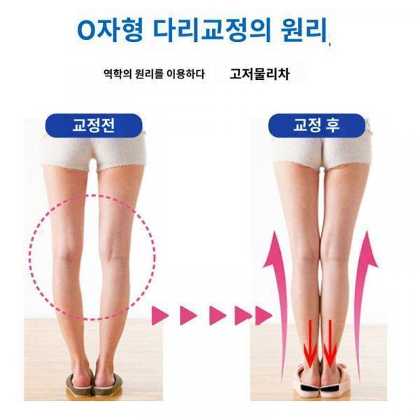 o-다리교정 인솔 내저외고 나선형 다리교정기 외팔자교정기